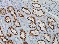 Kidney cancer stained with RCC