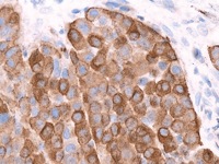 Melanoma stained with Pan Melanoma-2 antibody cocktail