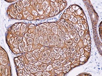 Skin tumor stained with Cytokeratin 14 antibody
