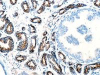 Prostate cancer stained with P504S antibody