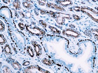 Prostate cancer stained with PIN Cocktail antibody