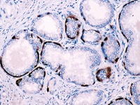 Prostate stained with HMW CK (CK5 + CK14) + p63 antibody cocktail