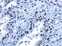 Squamous cell carcinoma stained with Retinoblastoma antibody