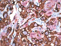 Melanoma stained with Pan Melanoma + S100 antibody cocktail