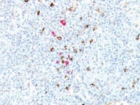 Neoplastic lymphoma stained with Kappa + Lambda