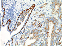 Prostate cancer stained with PIN-4 antibody cocktail.