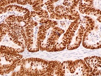 Colon cancer stained with CDX2 antibody
