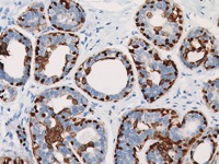 Breast cancer stained with CK5 + p63 Cocktail