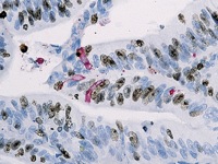 Colon cancer stained with Ki-67 (DAB) + Caspase-3 (FR)