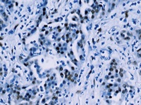 Mesothelioma stained with WT1 antibody