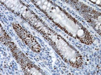Colon cancer stained with MSH6 antibody