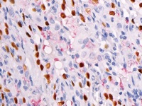 Double stain of Surfactant Apoprotein-A (red) and TTF-1 (brown)