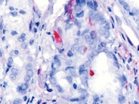 Prostate cancer stained with PTEN antibody