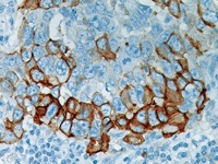 Breast cancer stained with Phosphorylated EGFR rabbit  monoclonal antibody