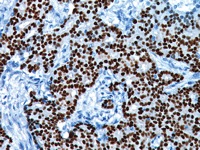 Breast cancer stained with ER