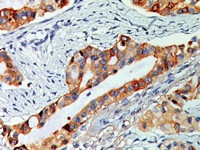 Colon cancer stained with COX-2