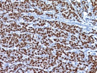 Breast cancer stained with Broad Spectrum Estrogen Receptor Broad Spectrum antibody