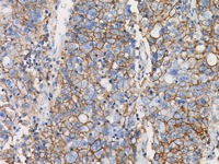 Breast cancer stained with CD44