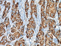 Breast cancer stained with MUC-1 antibody