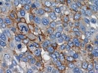 Breast cancer stained with CD24 antibody