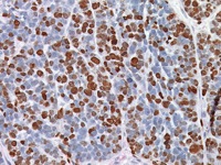 Breast cancer stained with Ki-67 antibody
