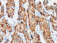 Breast cancer stained with MUC-4 antibody