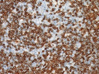 Mantle cell lymphoma stained with CD5 antibody