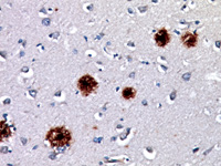 Alzheimer’s brain stained with Beta-Amyloid antibody