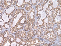 Breast cancer stained with CK7 antibody
