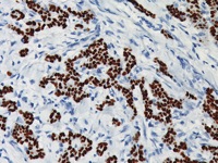 Breast cancer stained with PR [PgR636]