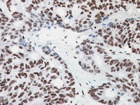 Colon cancer stained with PMS2 antibody