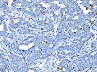 Breast cancer stained with BRCA-1 antibody