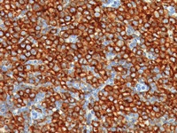 Hodgkin’s stained with CD30 antibody