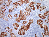 Breast cancer stained with HIF-1-alpha antibody