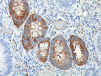 Colon cancer stem cells stained with ALDH1a1