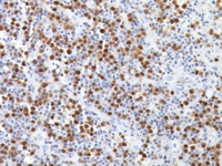 Multiple myeloma stained with MUM-1 rabbit monoclonal antibody