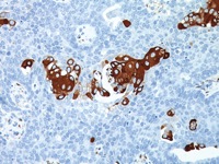 Ovarian cancer stained with VEGF antibody