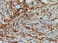 Dermatofibroma stained with Factor XIIIa