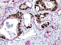Colon cancer (brown) metastasized into lung tissue (red).