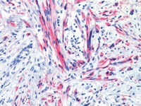 Neurotrophic melanoma stained with NGFR (FR)