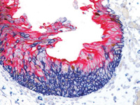 Reactive atypia meets CIS in bladder: CD44 (blue), p53 (DAB) & CK20 (FR)
