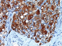 Pheochromocytoma stained with mouse Synaptophysin antibody