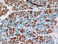 Breast cancer stained with Ki-67 antibody