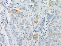 Bladder cancer stained with Uroplakin antibody