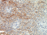 Bladder cancer stained with CD141 (Thrombomodulin) antibody