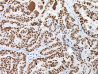 Serous ovarian adenocarcinoma stained with PAX8 antibody