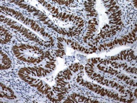 Colon cancer stained with EZH2 antibody