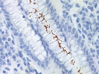 Stomach infected with H. pylori