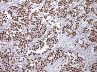 Seminoma stained with SALL4 antibody