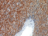 GIST stained with DOG1 antibody
